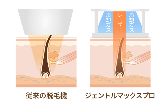 従来の脱毛機 ジェントルマックスプロ