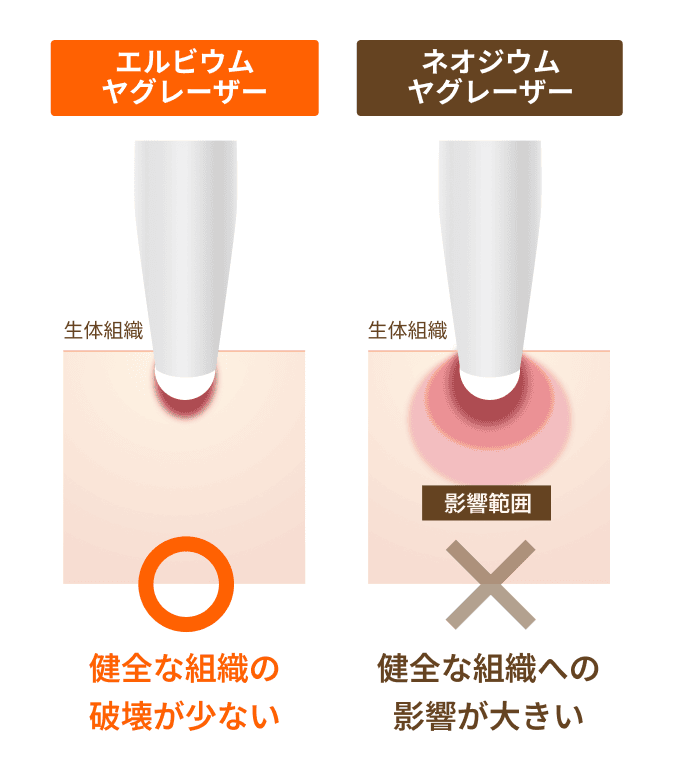 エルビウムヤグレーザー ネオジウムヤグレーザー違い